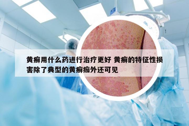 黄癣用什么药进行治疗更好 黄癣的特征性损害除了典型的黄癣痂外还可见