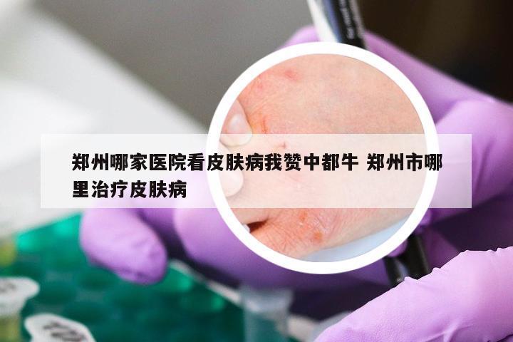 郑州哪家医院看皮肤病我赞中都牛 郑州市哪里治疗皮肤病