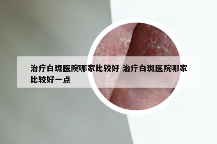 治疗白斑医院哪家比较好 治疗白斑医院哪家比较好一点