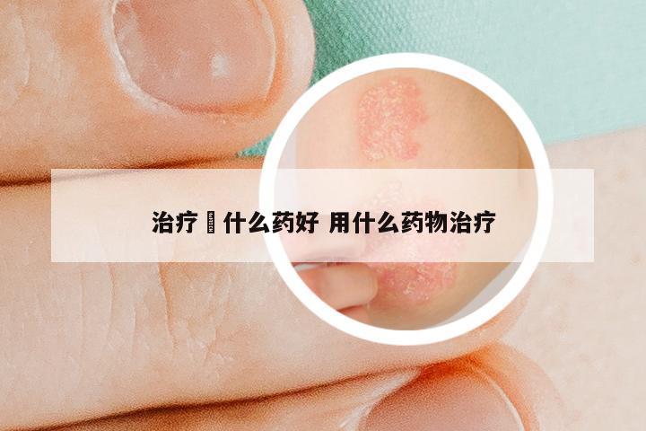 治疗廯什么药好 用什么药物治疗