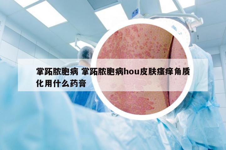 掌跖脓胞病 掌跖脓胞病hou皮肤瘙痒角质化用什么药膏