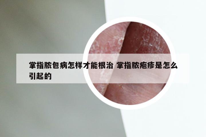 掌指脓包病怎样才能根治 掌指脓疱疹是怎么引起的