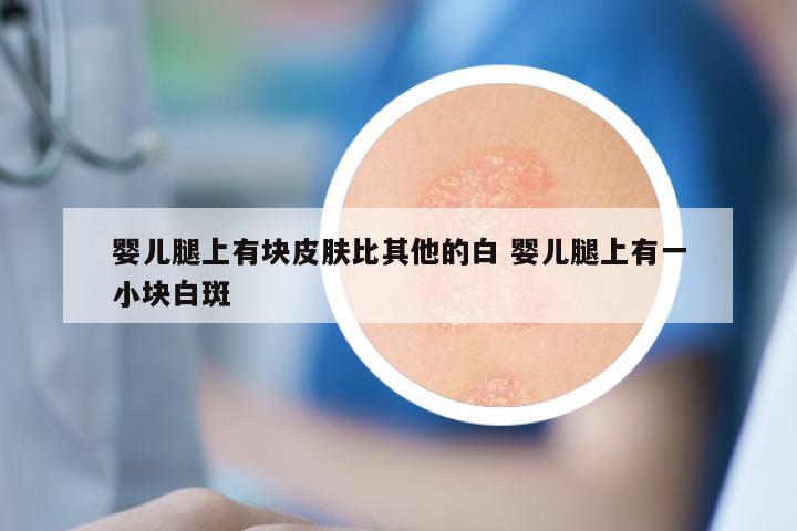 婴儿腿上有块皮肤比其他的白 婴儿腿上有一小块白斑