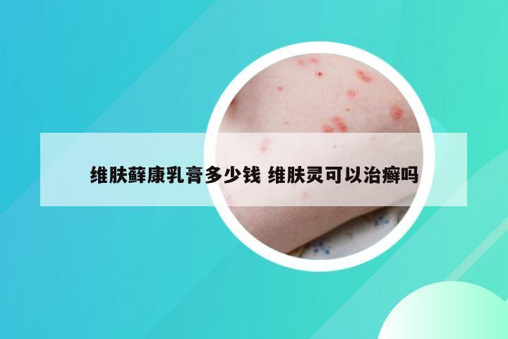 维肤藓康乳膏多少钱 维肤灵可以治癣吗