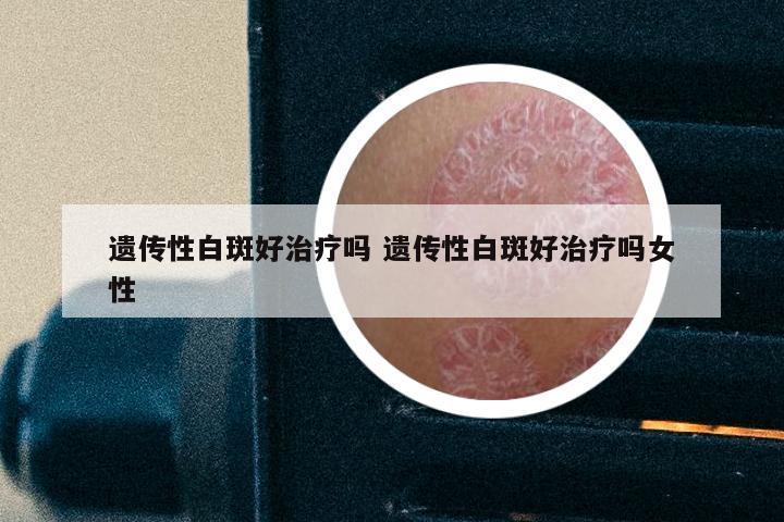 遗传性白斑好治疗吗 遗传性白斑好治疗吗女性