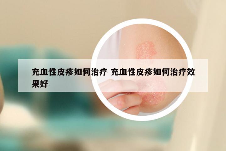 充血性皮疹如何治疗 充血性皮疹如何治疗效果好