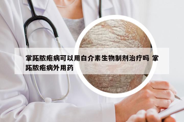 掌跖脓疱病可以用白介素生物制剂治疗吗 掌跖脓疱病外用药