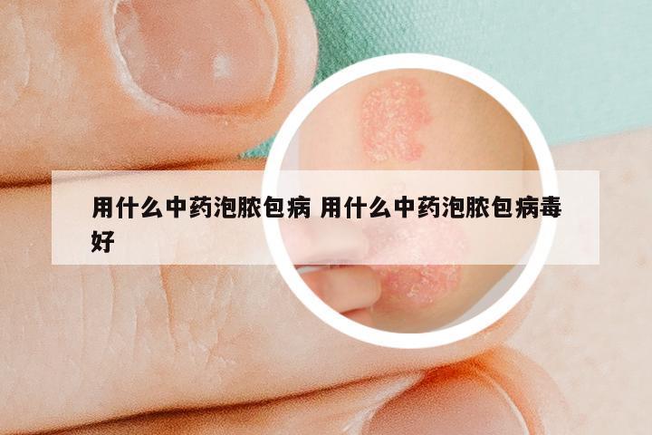 用什么中药泡脓包病 用什么中药泡脓包病毒好