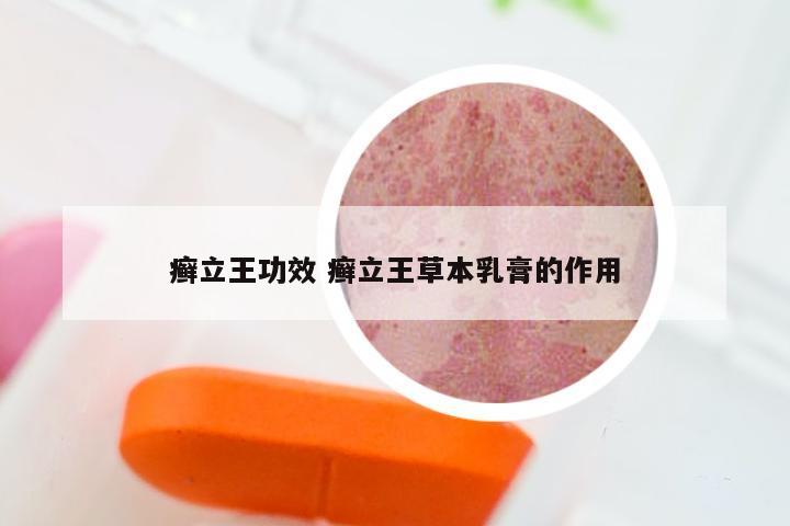 癣立王功效 癣立王草本乳膏的作用