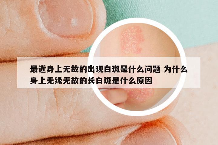 最近身上无故的出现白斑是什么问题 为什么身上无缘无故的长白斑是什么原因