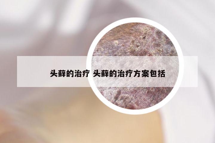 头藓的治疗 头藓的治疗方案包括