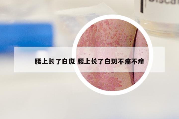 腰上长了白斑 腰上长了白斑不痛不痒