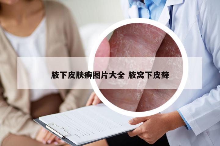 腋下皮肤癣图片大全 腋窝下皮藓