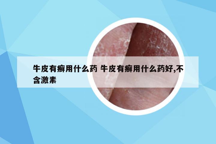 牛皮有癣用什么药 牛皮有癣用什么药好,不含激素