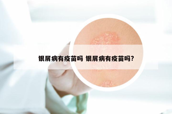 银屑病有疫苗吗 银屑病有疫苗吗?