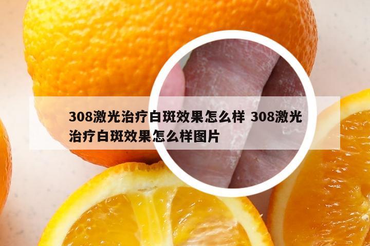 308激光治疗白斑效果怎么样 308激光治疗白斑效果怎么样图片