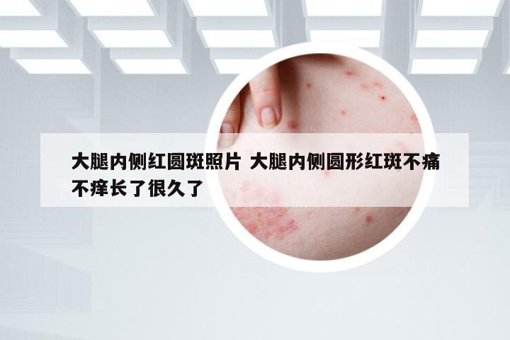 大腿内侧红圆斑照片 大腿内侧圆形红斑不痛不痒长了很久了