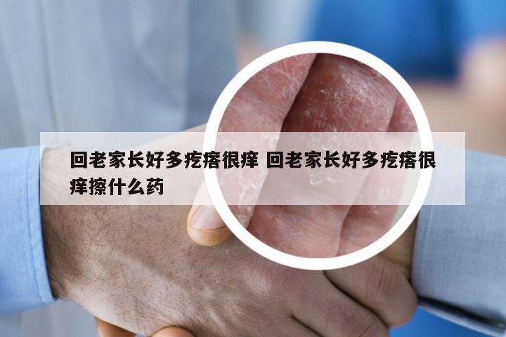 回老家长好多疙瘩很痒 回老家长好多疙瘩很痒擦什么药