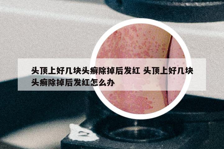 头顶上好几块头癣除掉后发红 头顶上好几块头癣除掉后发红怎么办