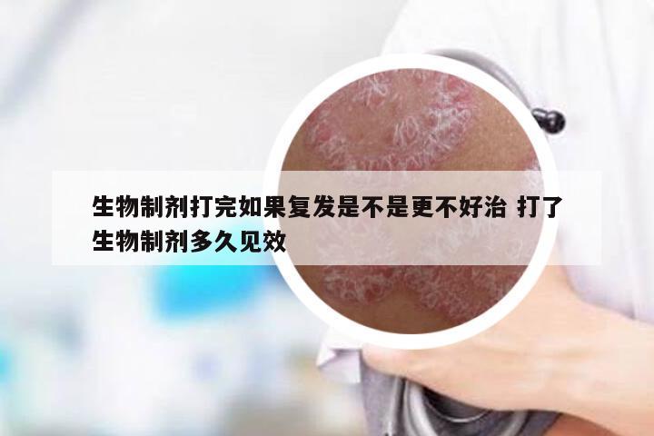 生物制剂打完如果复发是不是更不好治 打了生物制剂多久见效