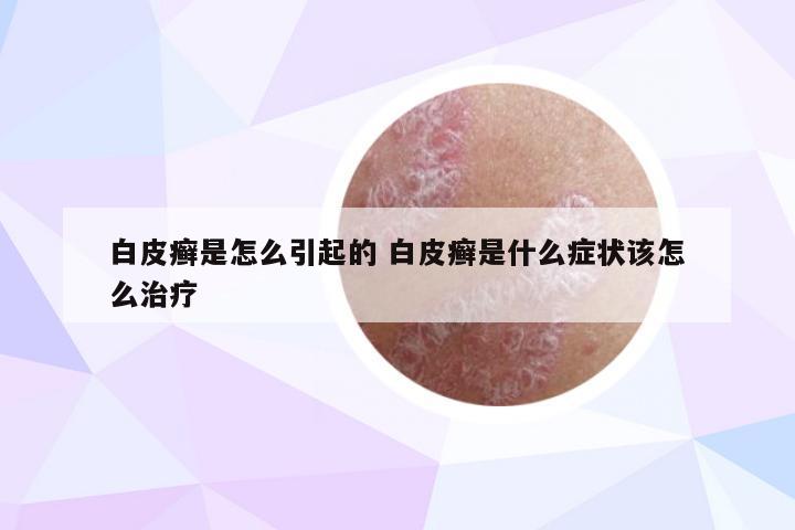 白皮癣是怎么引起的 白皮癣是什么症状该怎么治疗