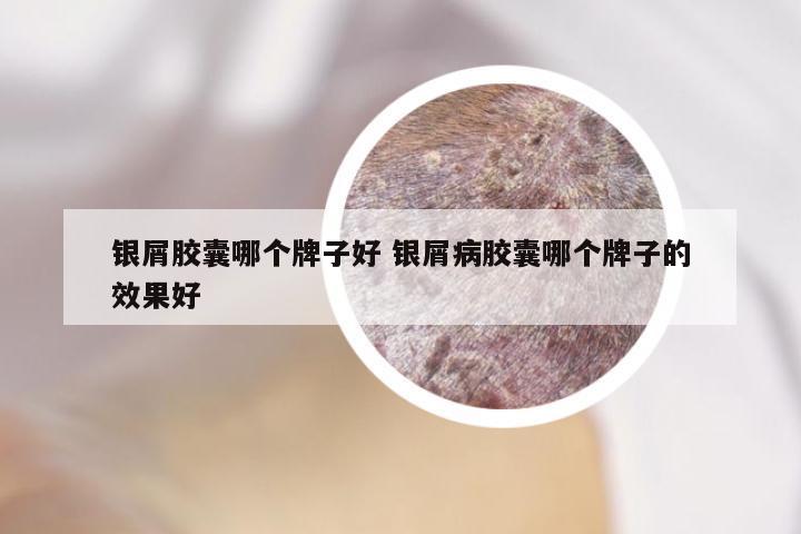 银屑胶囊哪个牌子好 银屑病胶囊哪个牌子的效果好