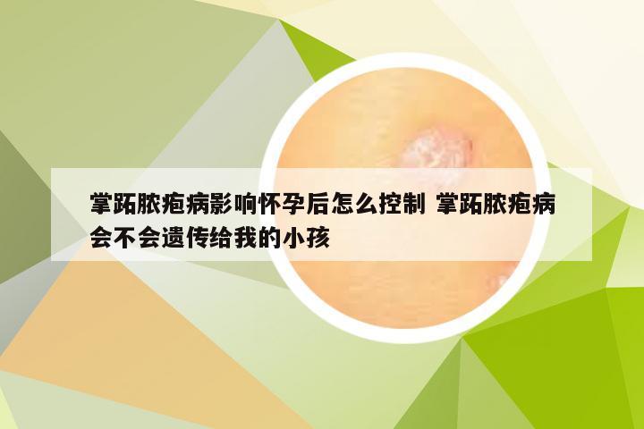 掌跖脓疱病影响怀孕后怎么控制 掌跖脓疱病会不会遗传给我的小孩