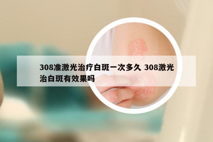 308准激光治疗白斑一次多久 308激光治白斑有效果吗