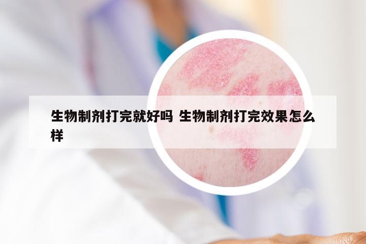 生物制剂打完就好吗 生物制剂打完效果怎么样