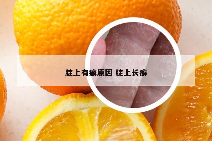 腚上有癣原因 腚上长癣