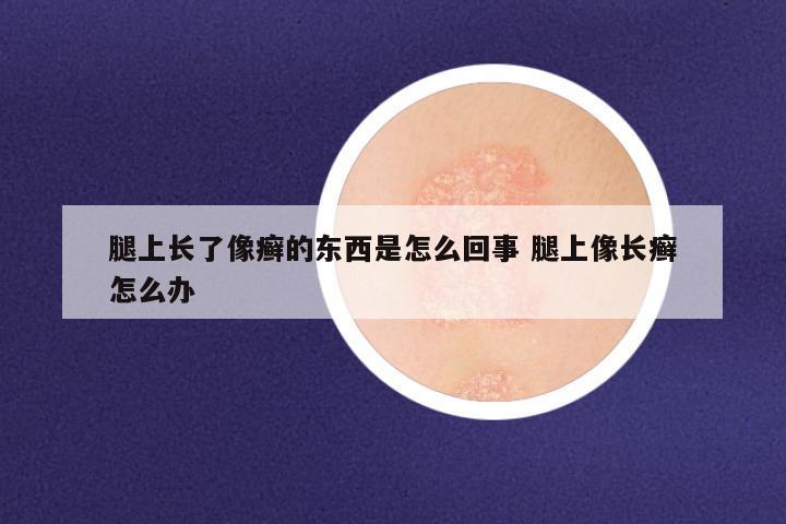 腿上长了像癣的东西是怎么回事 腿上像长癣怎么办