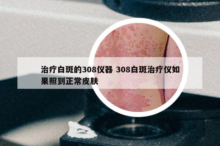 治疗白斑的308仪器 308白斑治疗仪如果照到正常皮肤