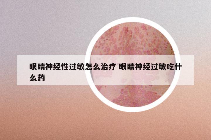 眼睛神经性过敏怎么治疗 眼睛神经过敏吃什么药