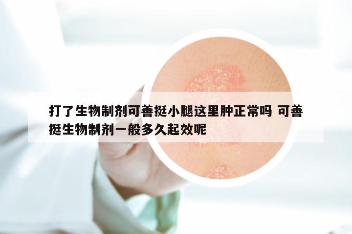 打了生物制剂可善挺小腿这里肿正常吗 可善挺生物制剂一般多久起效呢