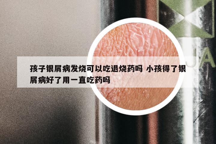 孩子银屑病发烧可以吃退烧药吗 小孩得了银屑病好了用一直吃药吗