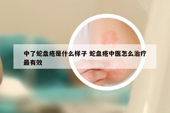 中了蛇盘疮是什么样子 蛇盘疮中医怎么治疗最有效