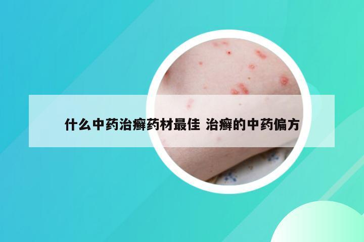 什么中药治癣药材最佳 治癣的中药偏方