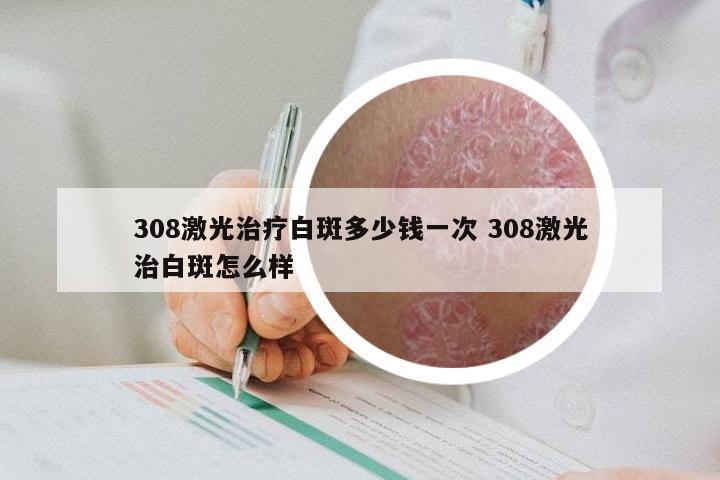 308激光治疗白斑多少钱一次 308激光治白斑怎么样