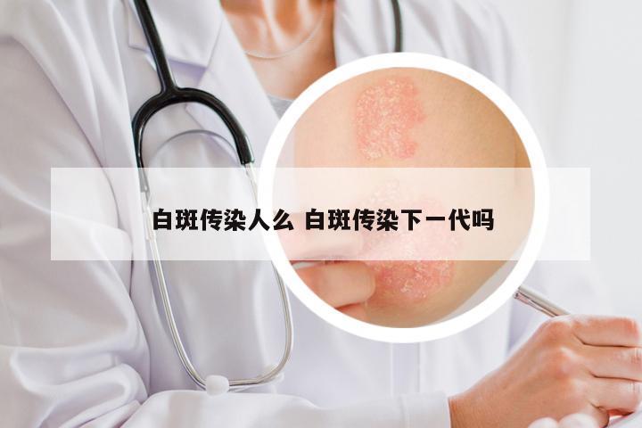 白斑传染人么 白斑传染下一代吗