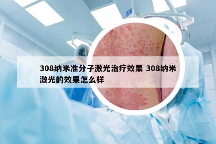 308纳米准分子激光治疗效果 308纳米激光的效果怎么样