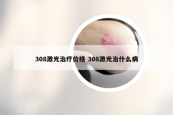 308激光治疗价格 308激光治什么病