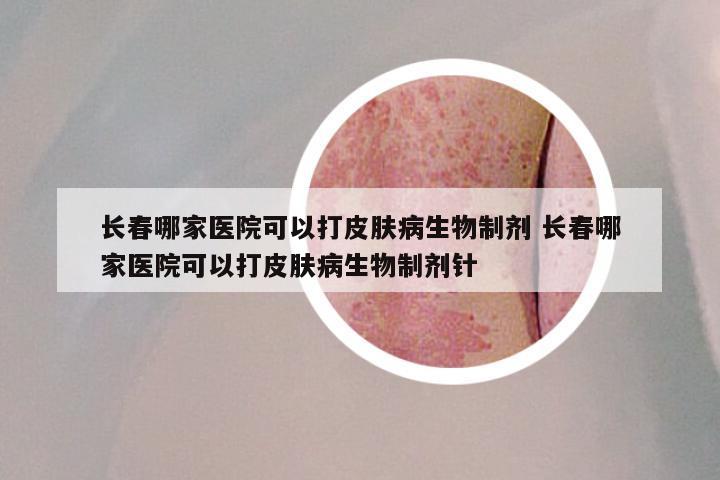 长春哪家医院可以打皮肤病生物制剂 长春哪家医院可以打皮肤病生物制剂针