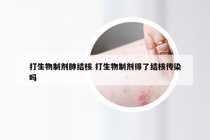 打生物制剂肺结核 打生物制剂得了结核传染吗