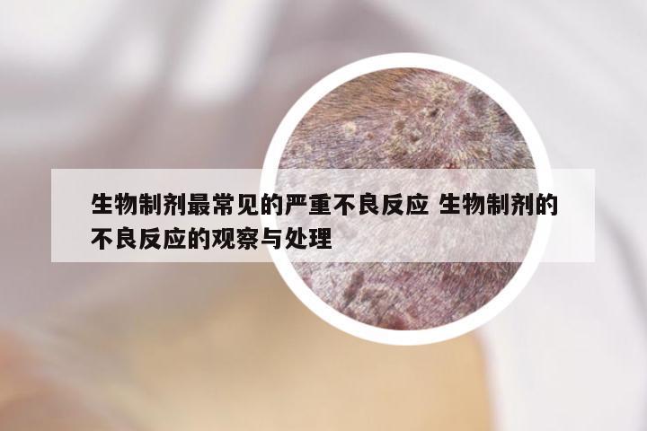 生物制剂最常见的严重不良反应 生物制剂的不良反应的观察与处理