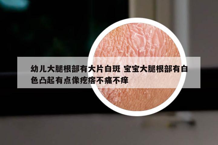 幼儿大腿根部有大片白斑 宝宝大腿根部有白色凸起有点像疙瘩不痛不痒