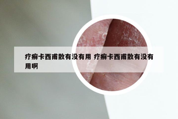 疗癣卡西甫散有没有用 疗癣卡西甫散有没有用啊