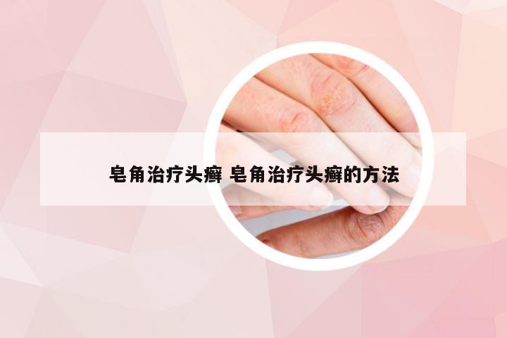 皂角治疗头癣 皂角治疗头癣的方法