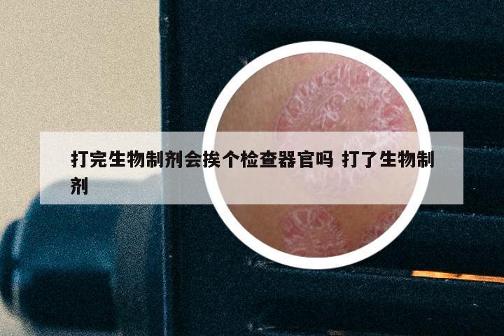 打完生物制剂会挨个检查器官吗 打了生物制剂