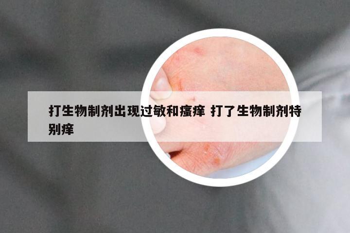 打生物制剂出现过敏和瘙痒 打了生物制剂特别痒