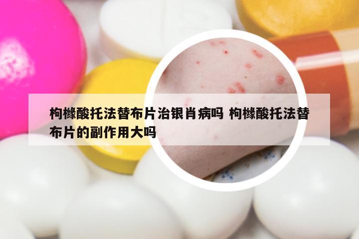 枸橼酸托法替布片治银肖病吗 枸橼酸托法替布片的副作用大吗